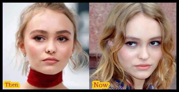 Lily-Rose Depp Plastische Chirurgie vor und nach Fotos  