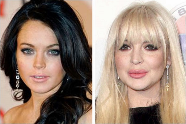 Lindsay Lohan Lip Injektionen Chirurgie vor und nach der Augmentation Fotos  