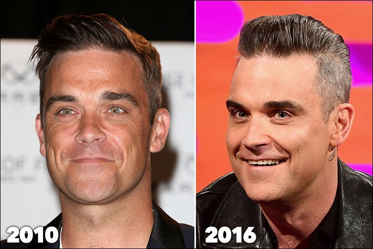 Robbie Williams Plastische Chirurgie vor und nach Botox Füller Fotos  