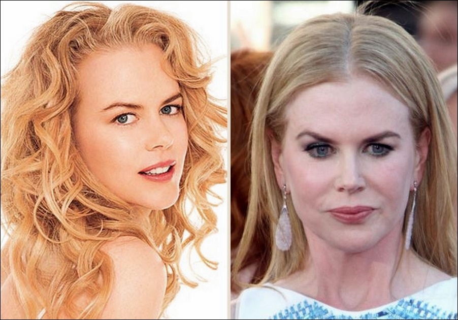 Nicole Kidman plastische Chirurgie für geschwollenes Aussehen  
