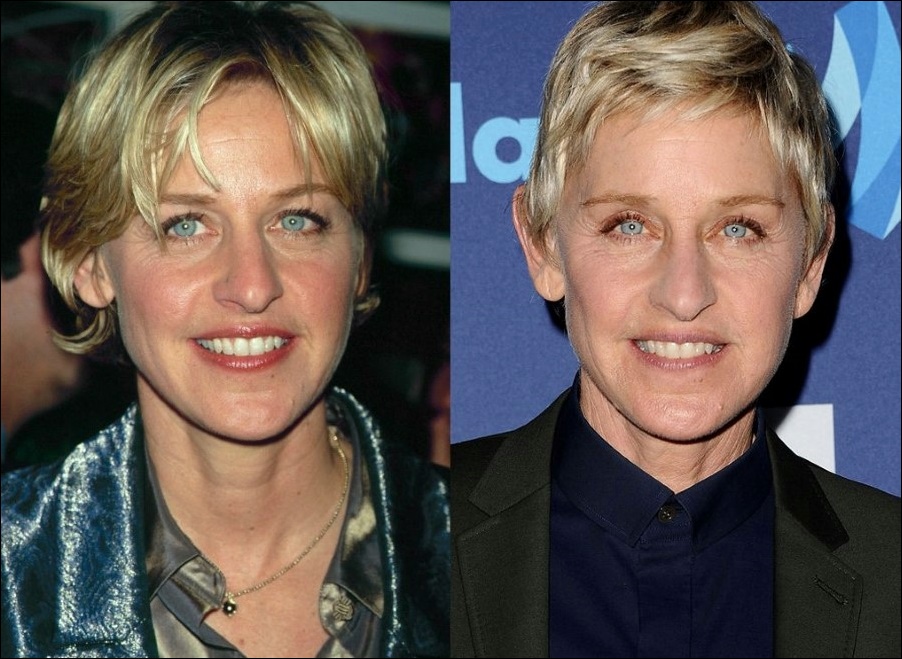 Ellen DeGeneres plastische Chirurgie - Warum sie so jung aussieht?  