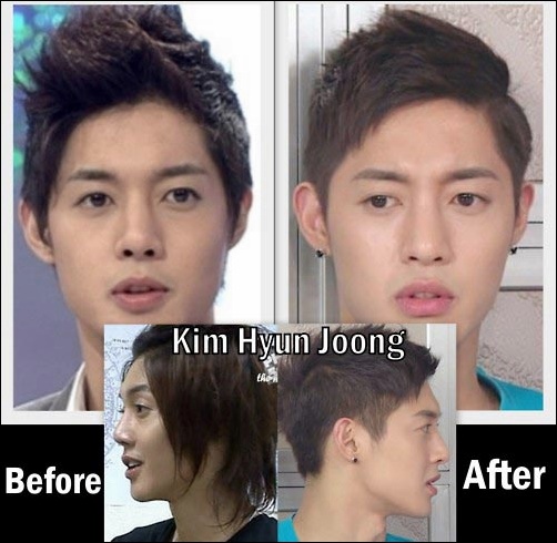 Kim Hyun Joong Plastische Chirurgie Vorher und Nachher  