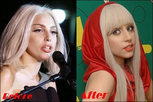 Lady Gaga Nasenoperation vor und nach Fotos  