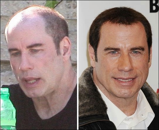 John Travolta Schönheitsoperation entfernt Falten und Haare hinzugefügt?  