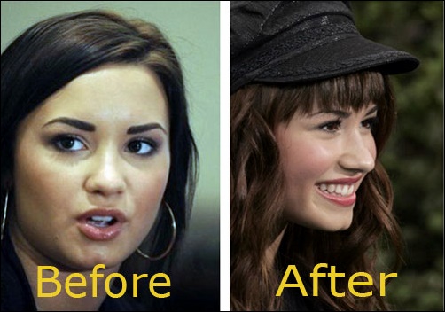 Demi Lovato Plastische Chirurgie Vorher-Nachher Bilder  