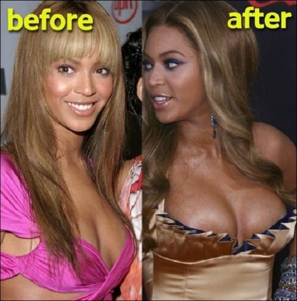 Beyonce Plastische Chirurgie - Leichtere Haut und größere Brüste!  
