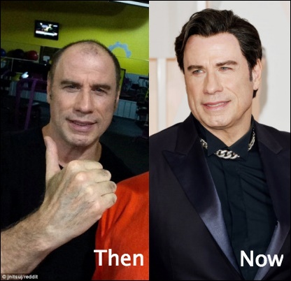 John Travolta Haartransplantation vor und nach Bildern  