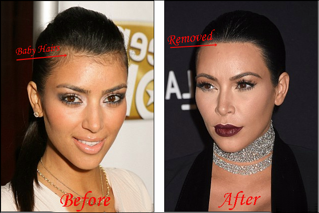 Kim Kardashian Laser-Haarentfernung Vorher-Nachher Bilder  