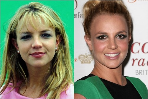Best Celebrity Nose Job vor und nach Nasenkorrektur Fotos  