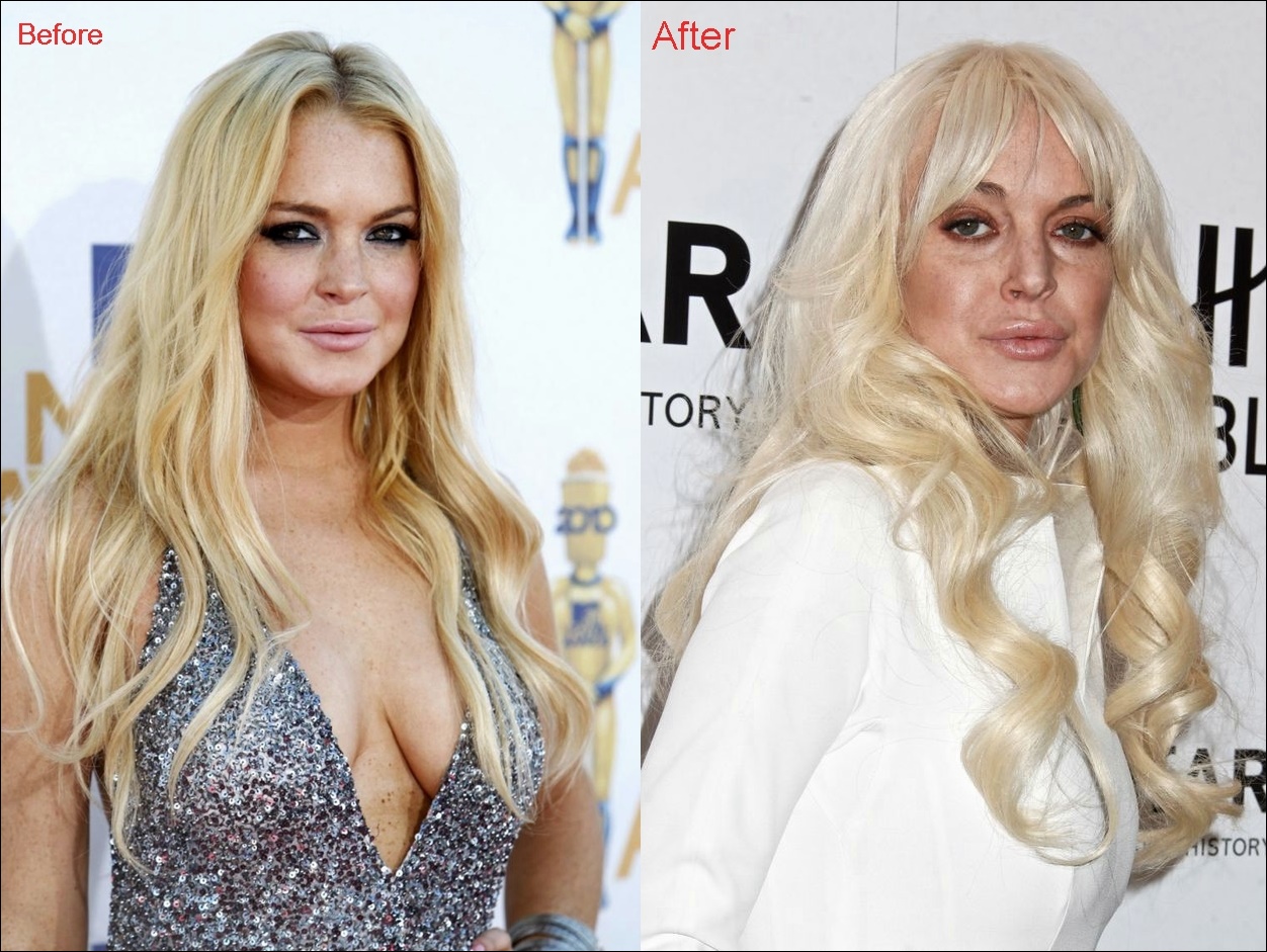 Lindsay Lohan Lip Injektionen Chirurgie vor und nach der Augmentation Fotos  