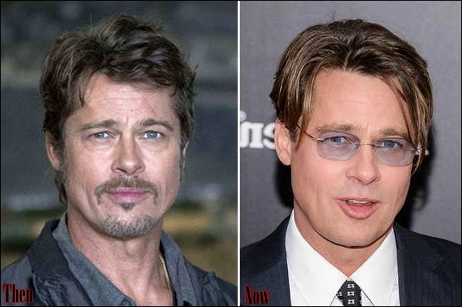 Brad Pitt Plastische Chirurgie vor und nach Facelift, Nase Job  