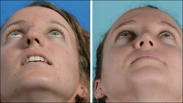 Crooked Nase vor und nach Nasenkorrektur Nasenoperation Fotos  