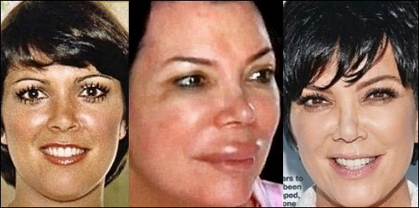 Kris Jenner perfekte plastische Chirurgie für 59 Jahre alte Mutter!  