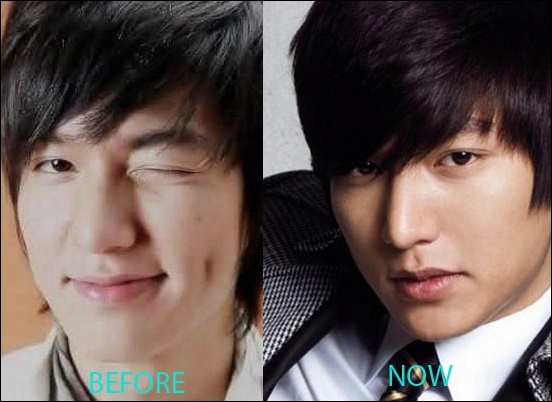 Lee Min Ho Plastische Chirurgie vor und nach kosmetischen Fotos  
