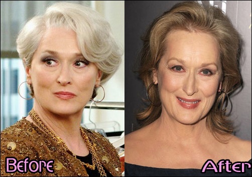 Meryl Streep Plastische Chirurgie Vorher-Nachher Bilder  