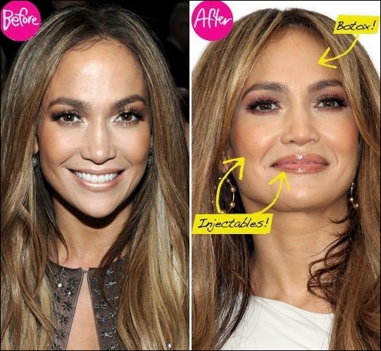 Jennifer Lopez J-Lo - Plastische Chirurgie zwickt für perfektes Aussehen?  