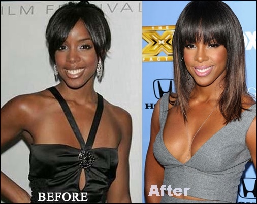 Schwarze Prominente vor und nach der plastischen Chirurgie Fotos  