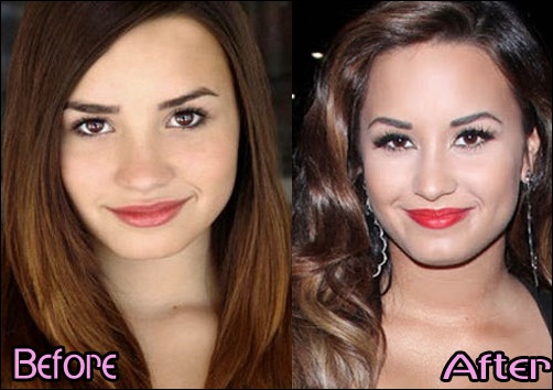 Demi Lovato Nase Job vor und nach der plastischen Chirurgie Fotos  