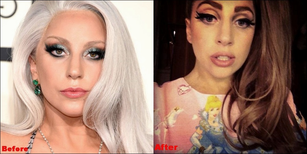 Lady Gaga Lip Injektionen vor und nach Fotos  