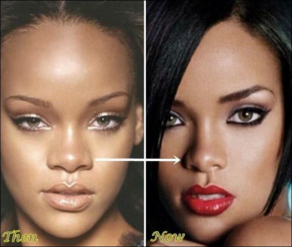 Rihanna sieht professioneller nach Plastische Chirurgie aus?  