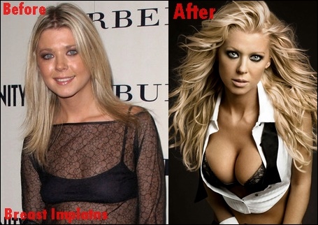 Tara Reid Brustimplantate Plastische Chirurgie vor und nach Titten Job-Fotos  