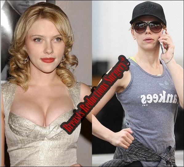 Scarlett Johansson Brustverkleinerung Plastische Chirurgie vor und nach Showcase  