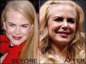 Nicole Kidman vor und nach der plastischen Chirurgie Bilder  