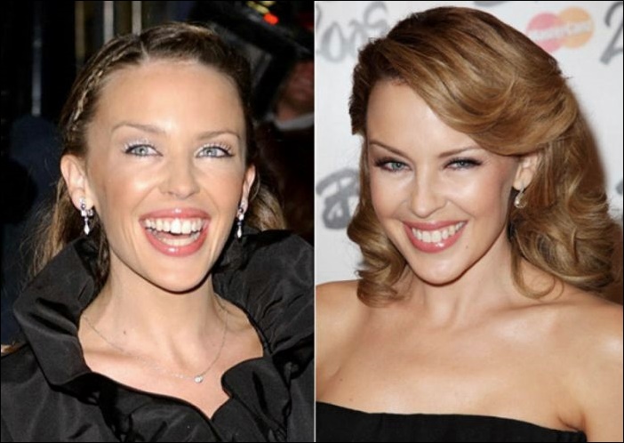 Kylie Minogue Nachrichten und Fakten über plastische Chirurgie  