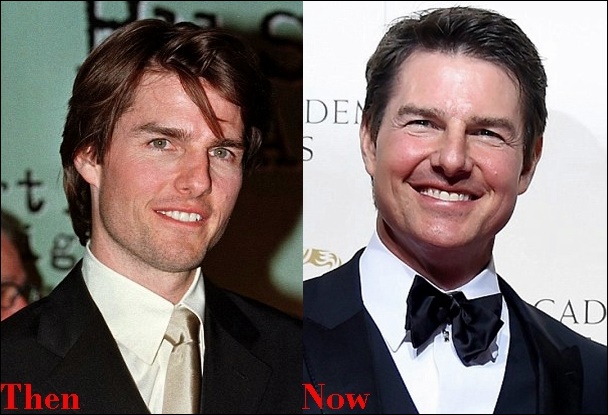 Tom Cruise Cosmetics Plastische Chirurgie vor und nach Gesicht Fotos  