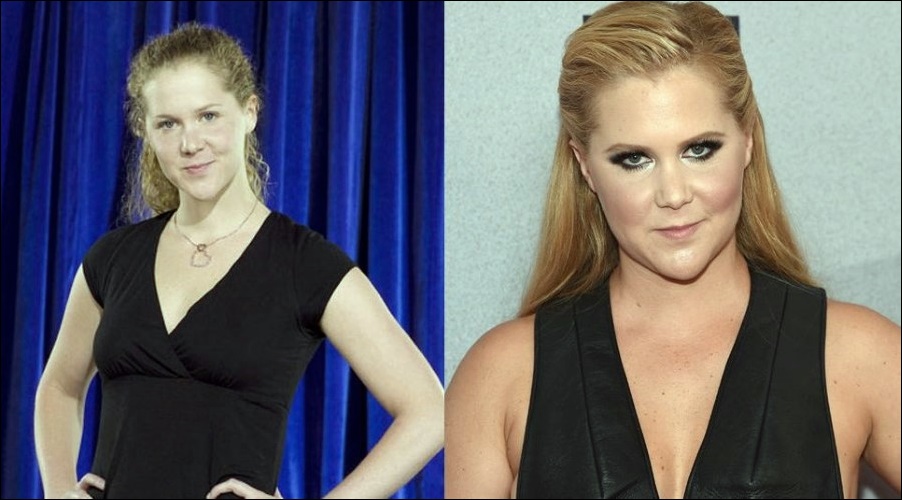 Amy Schumer Plastische Operationen  