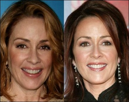 Patricia Heaton Plastische Chirurgie  