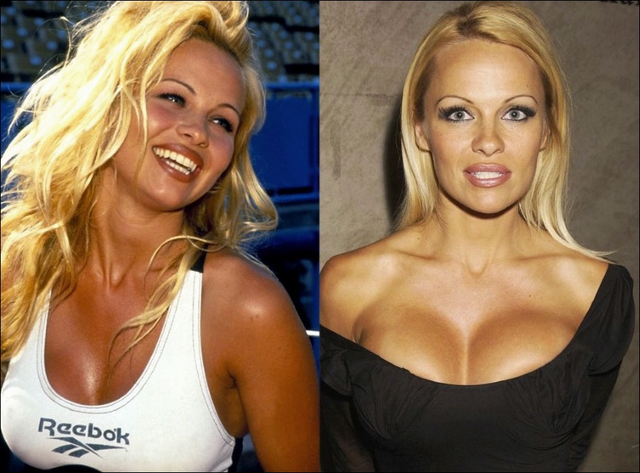 Pamela Anderson und Plastische Chirurgie  