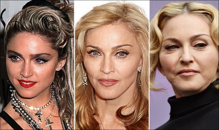 Madonna - welche plastischen Operationen hatte sie?  