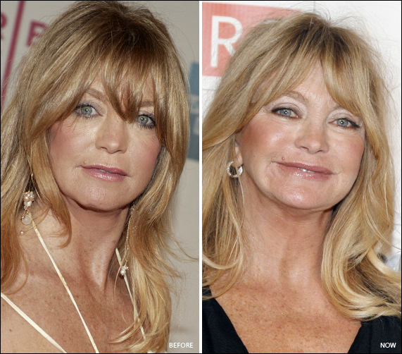 Goldie Hawn Plastische Chirurgie vor und nach Fotos  