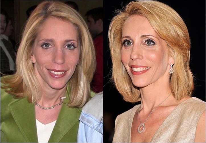 Dana Bash Plastische Chirurgie vor und nach Fotos  