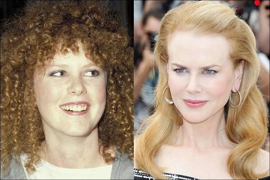 Nicole Kidman und ihre plastischen Operationen  