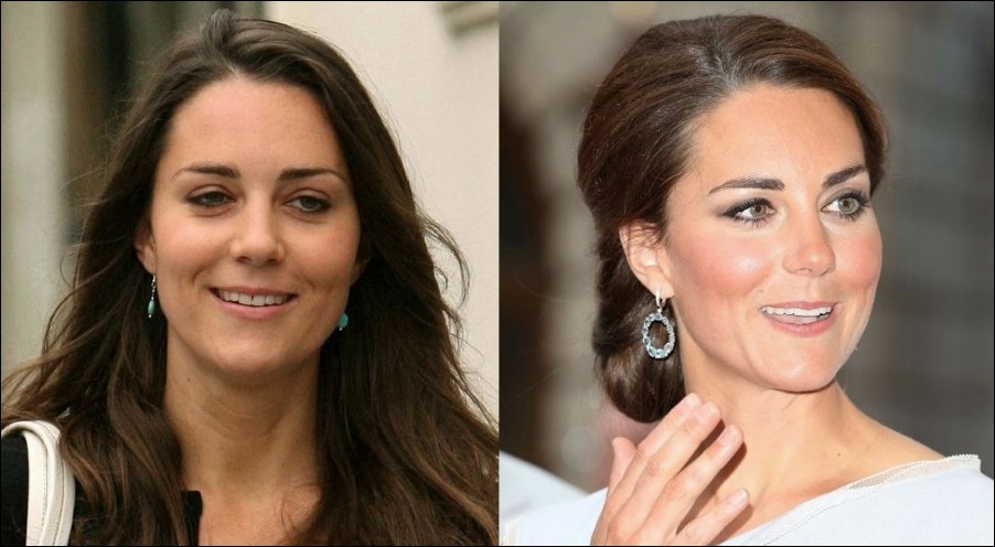 Kate Middleton Die Herzogin von Cambridge hatte Plastische Chirurgie erlitten?  
