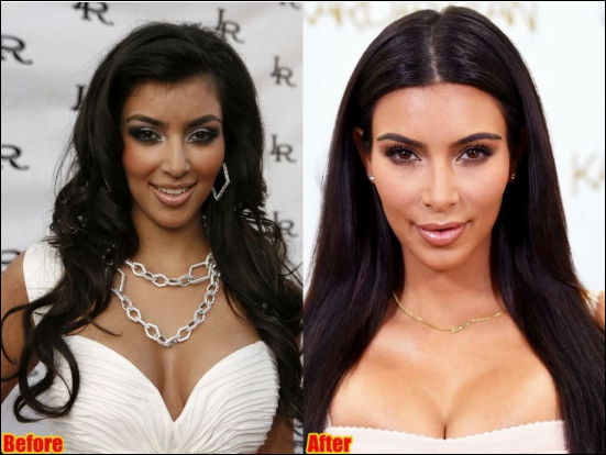 Kim Kardashian Kosmetische Chirurgie Vorher-Nachher Fotos  