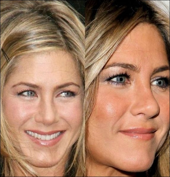 Jennifer Aniston plastische Chirurgie für geschwollene aussieht  