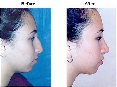 Crooked Nase vor und nach Nasenkorrektur Nasenoperation Fotos  