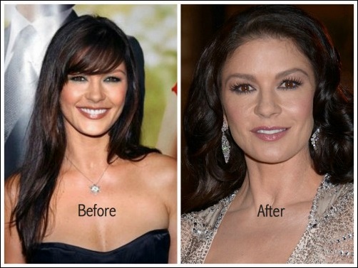 Catherine Zeta Jones Plastische Chirurgie vor und nach Face Lift, Brustimplantate  
