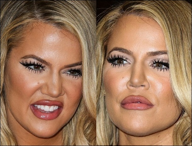 Khloe Kardashian falsche plastische Chirurgie vor und nach Füller Fotos  