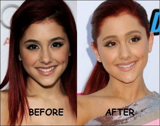 Ariana Grande Botched Plastische Chirurgie vor und nach Gesicht Fotos  