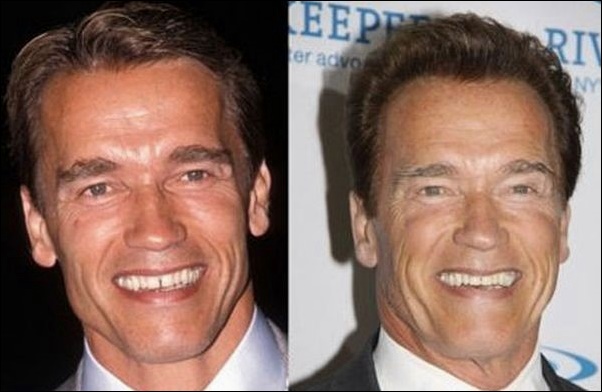 Arnold Schwarzenegger Bodybuilding und plastische Chirurgie  