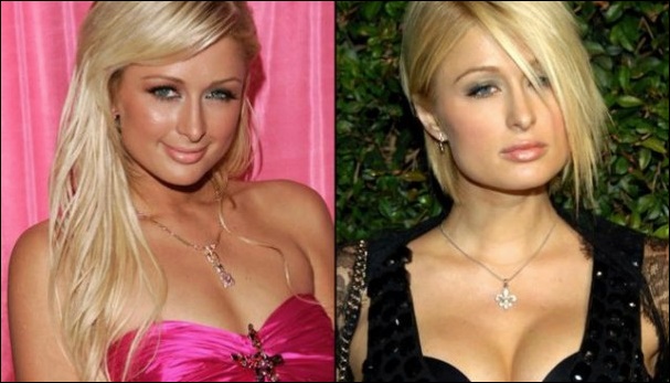 Paris Hilton Brustimplantate Plastische Chirurgie vor und nach Titten Job  