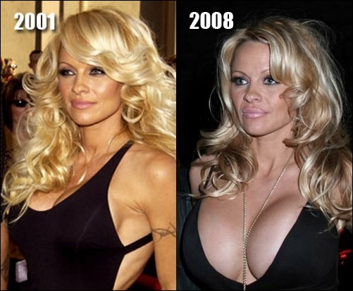 Pamela Anderson Plastische Chirurgie vor und nach Fotos  
