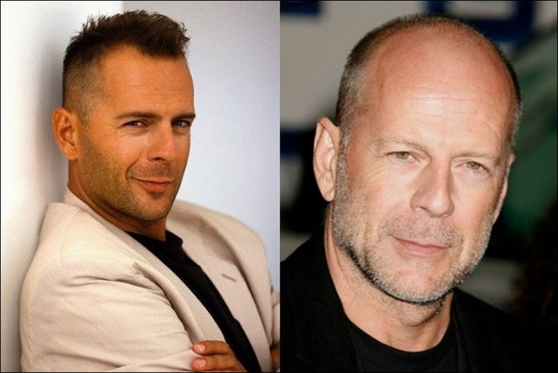 Bruce Willis Männlichkeit und plastische Chirurgie  
