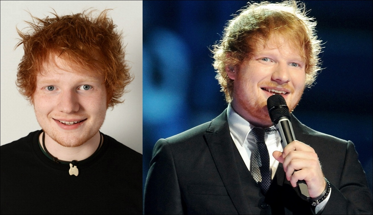 Ed Sheeran Plastische Chirurgie vor und nach Gesicht Fotos  