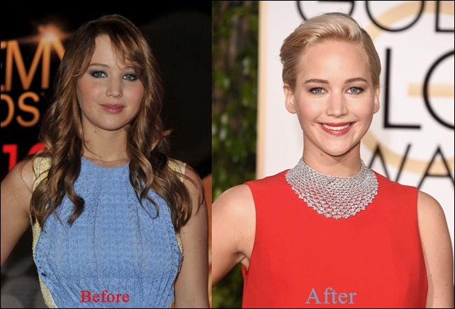 Jennifer Lawrence Plastische Chirurgie vor und nach dem Gesicht  