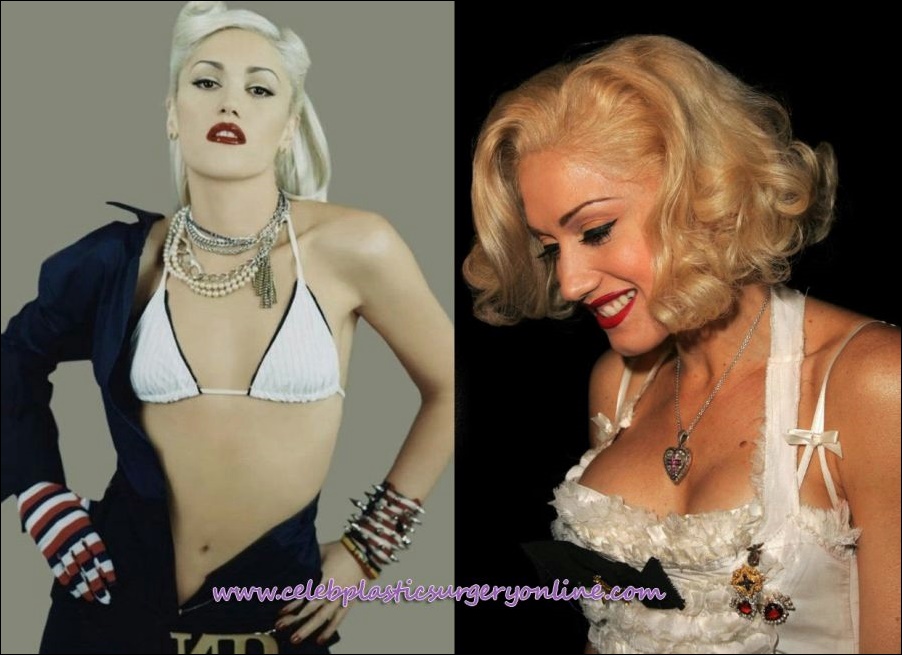 Gwen Stefani plastische Chirurgie Verbesserungen  
